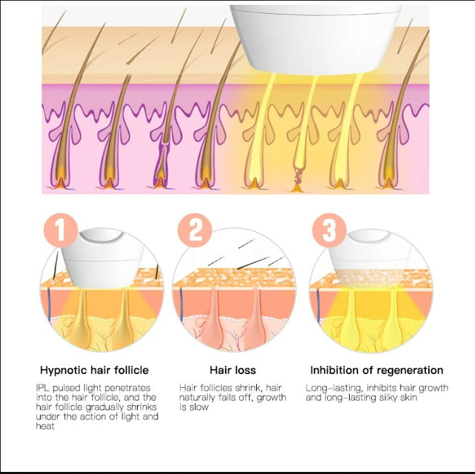 IPL Laser Hair Removal - Pink